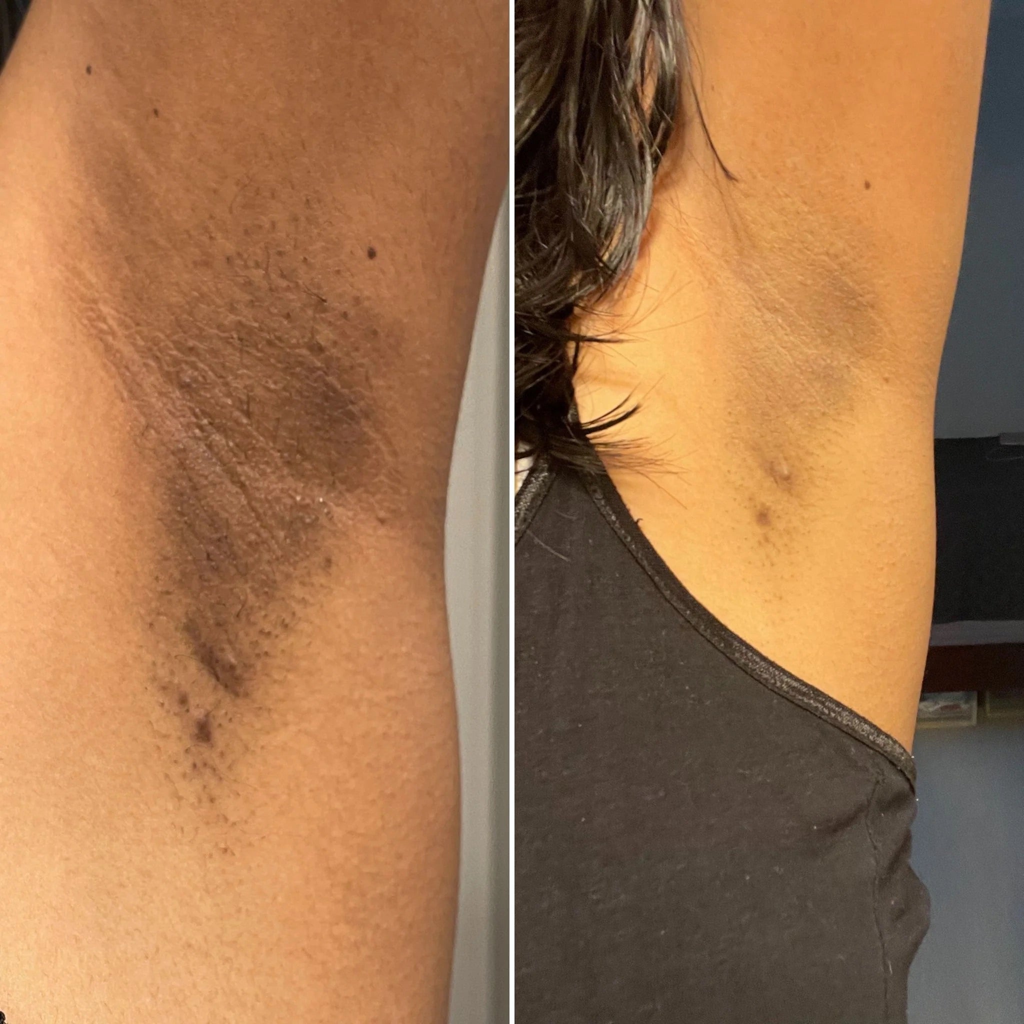 Savon éclaircissant à l’acide kojic